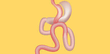 Bariatric Weight Loss Surgery- Mini Gastric Bypass - Habilite Clinics 
