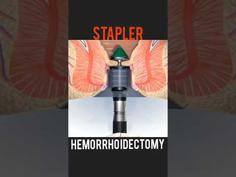 Stapler vs Laser vs DGHAL – Choosing the Right Technique