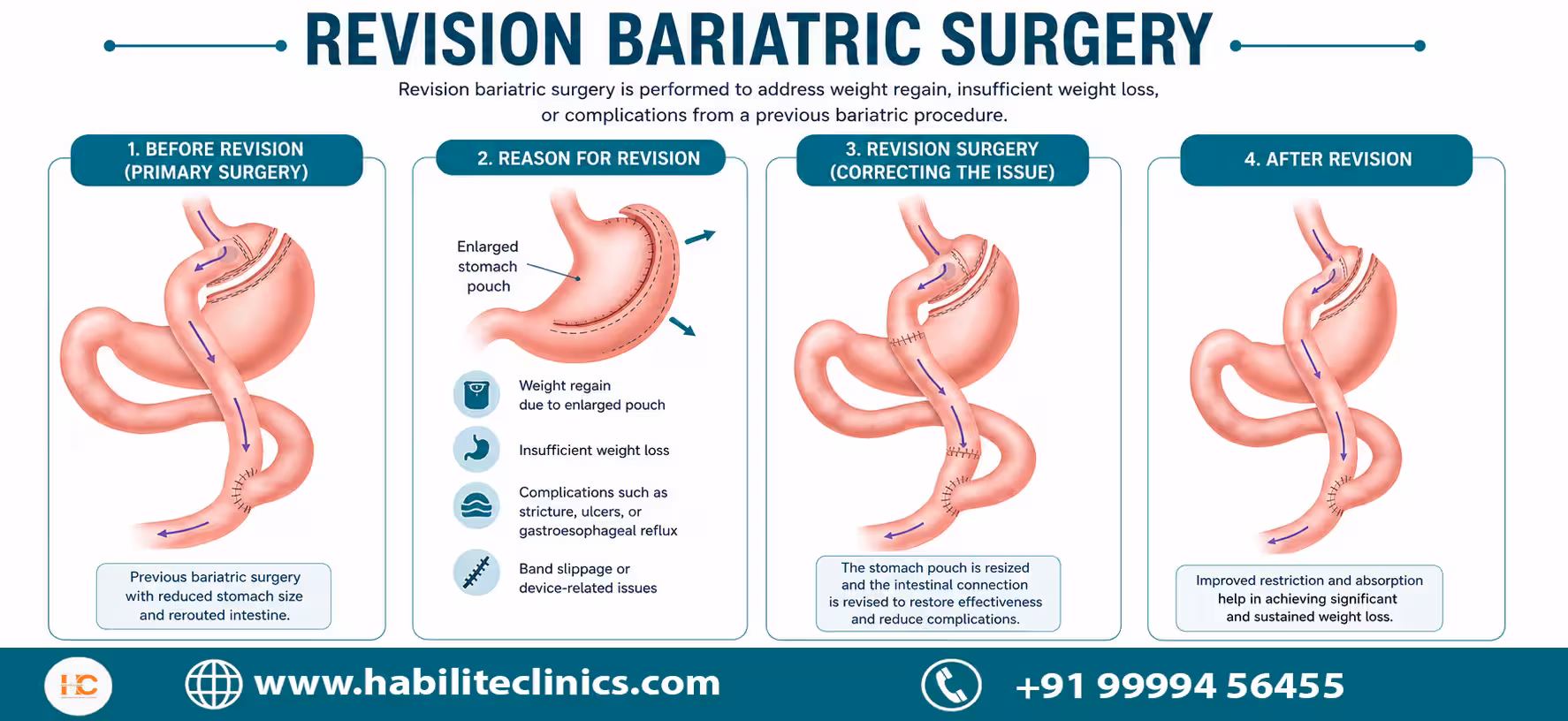 what is Revision Bariatric Surgery