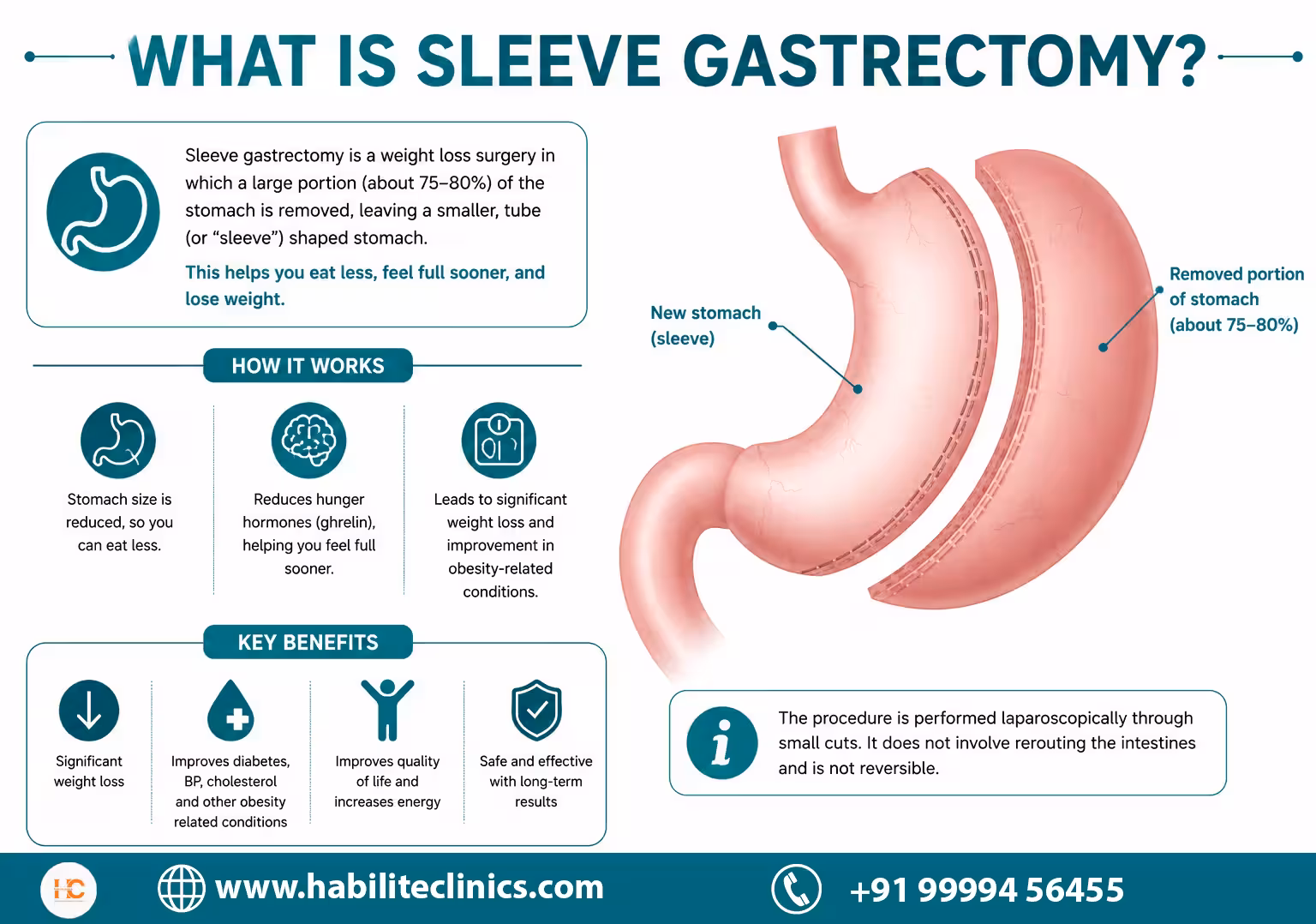 Sleeve Gastrectomy