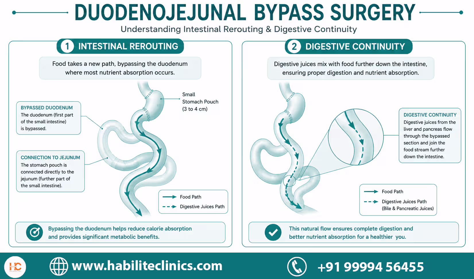 Duodenojejunal bypass procedure