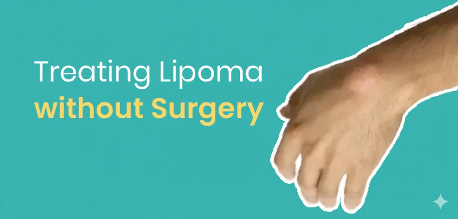 How to Remove Lipoma Naturally: Remedies and Treatment
