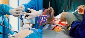 Laparoscopic vs Open Gallbladder Surgery: What's Right for You?