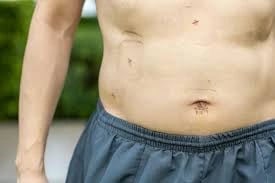 Life After Gallbladder Removal: What to Expect in 6 Months