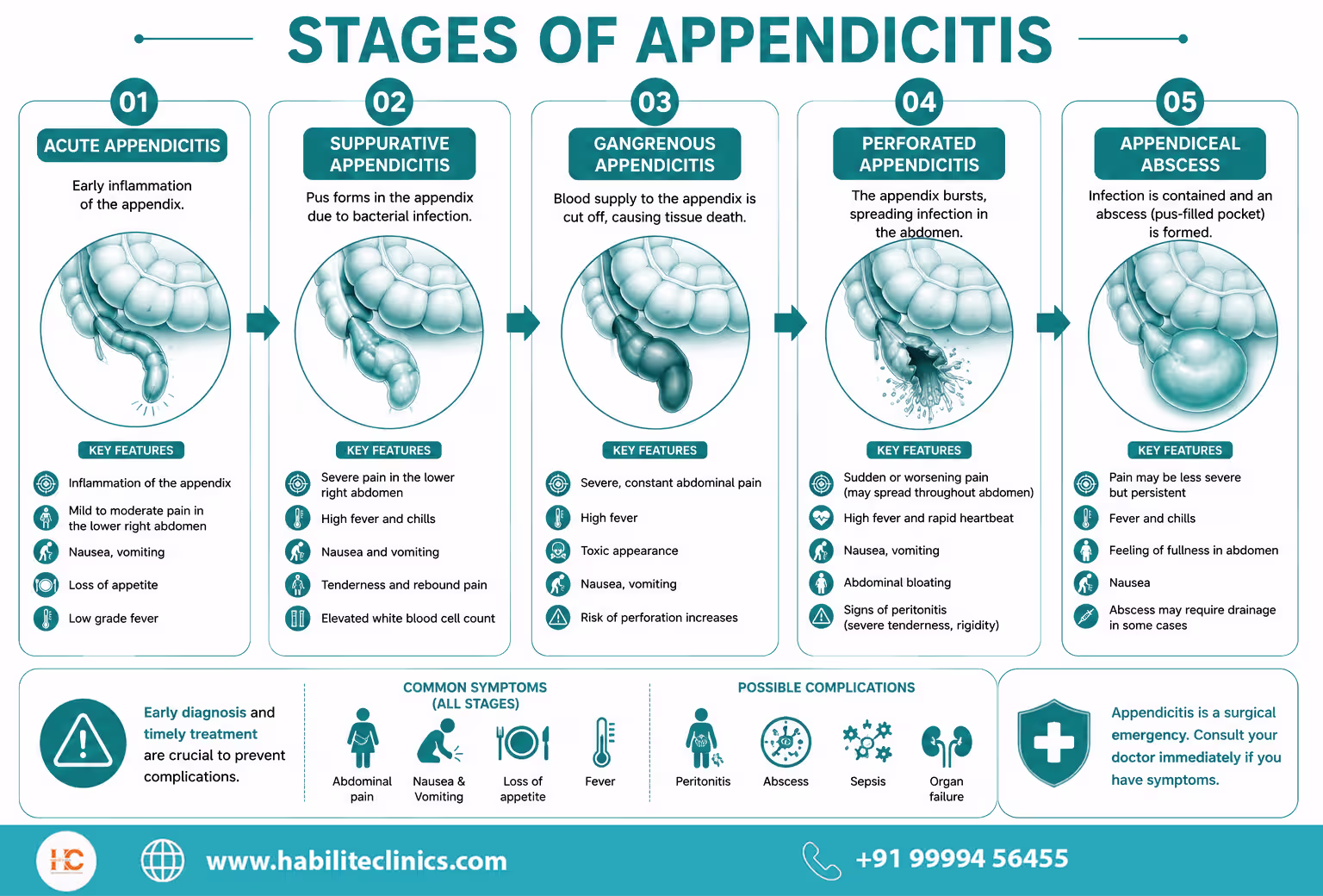 stages of appendicitis