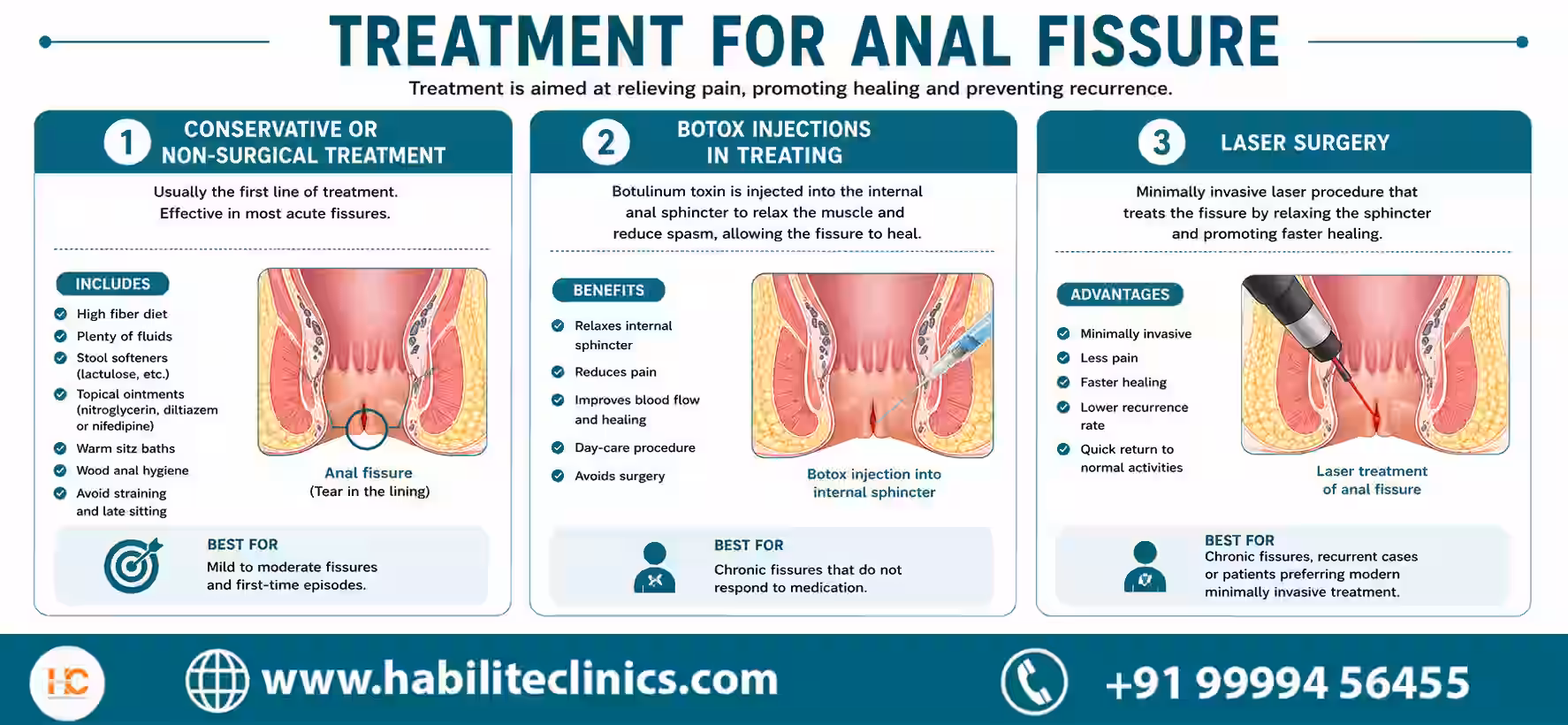 types of treatment for anal fissure