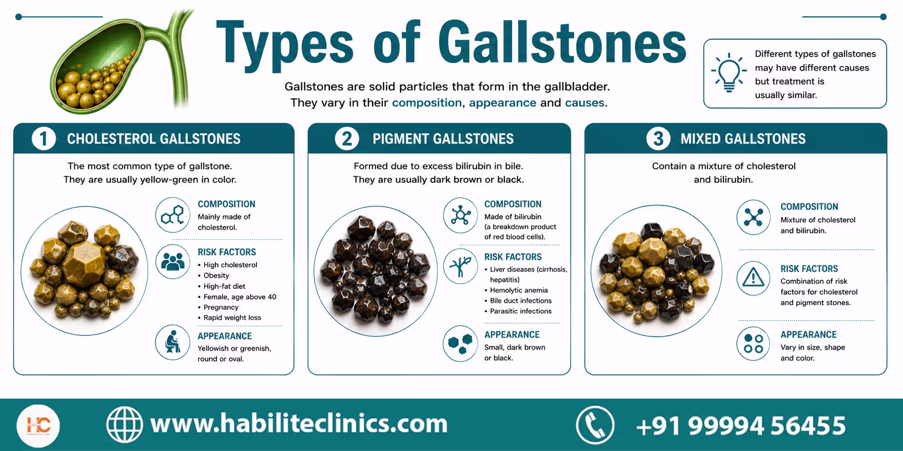 Types of Gallstones