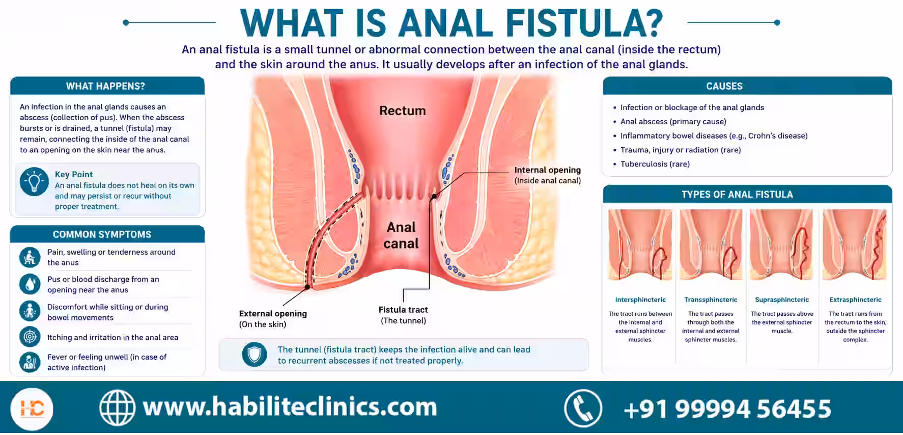 understanding anal fistula