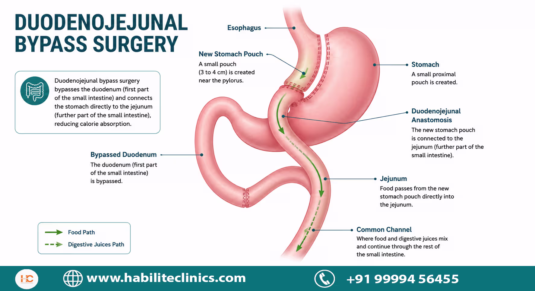what Is duodenojejunal bypass surgery