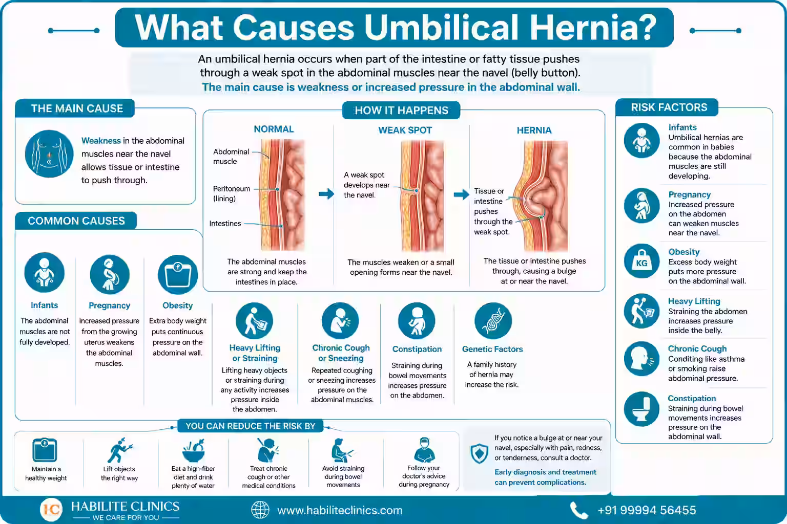 what causes Umbilical Hernia