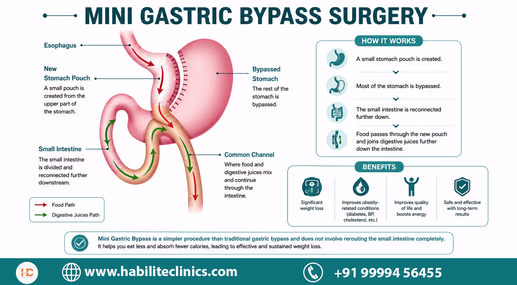 what is minigastric bypass