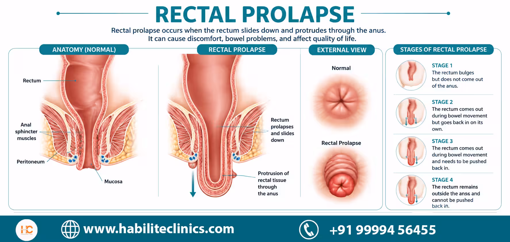 what is rectal prolapse