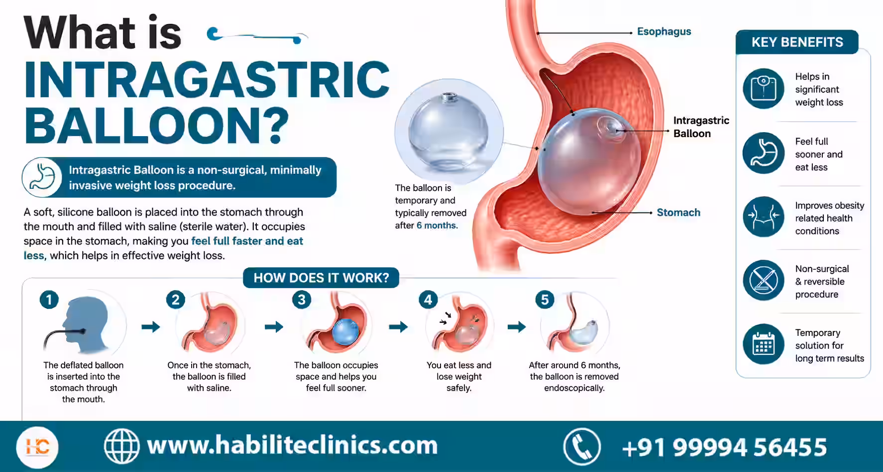 what is Intragastric Balloon