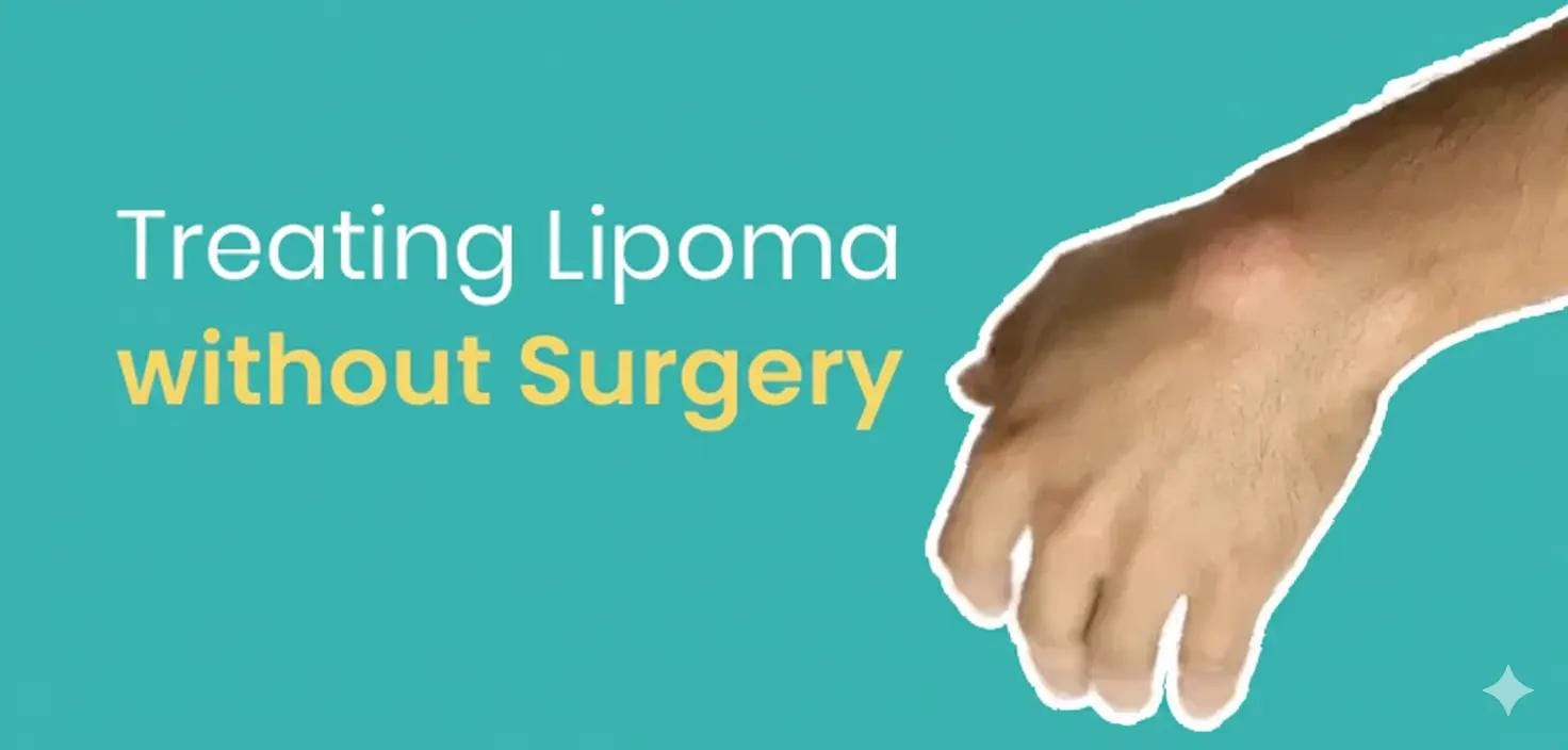How to Remove Lipoma Naturally: Remedies and Treatment