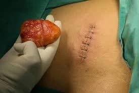 Lipoma Surgery: What is Done During the Procedure? Step-by-Step Guide