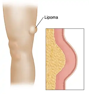  Best Lipoma Treatment in Delhi 