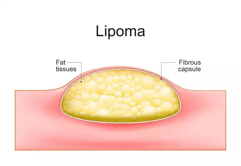 Best Lipoma Treatment in Delhi 