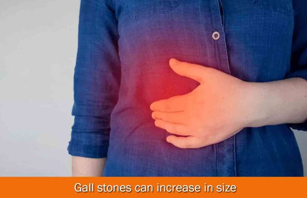 Gall stones can increase in size