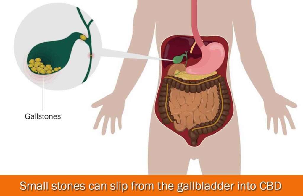 Small stones can slip from the gallbladder