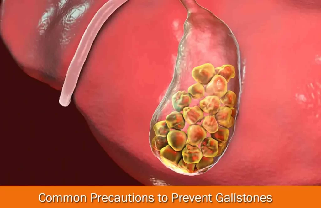 common precautions in gallstone