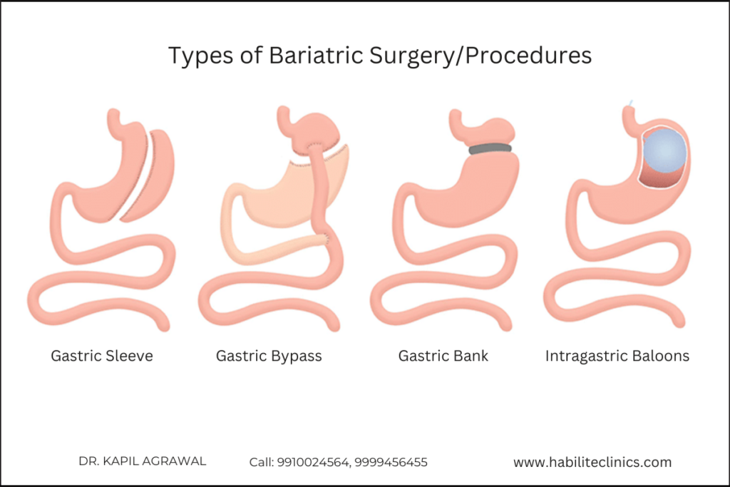 Bariatric Surgery Cost in Delhi,India