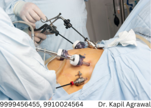 Laparoscopic approach to Bariatric surgery